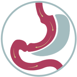 Gastric Sleeve