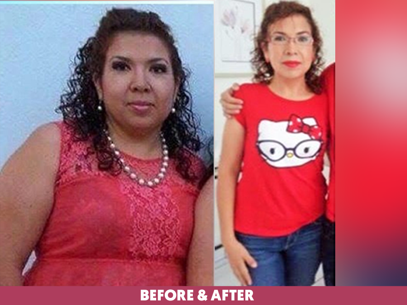Danira-Before-After-Bariatric-Gastric-Sleeve.png