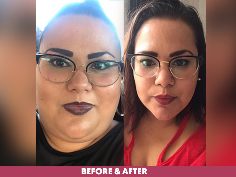 Gabriela-Before-After-Bariatric-Gastric-Sleeve.png