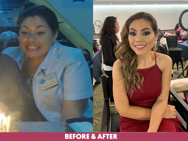 Gabriela-R-Before-After-Bariatric-Gastric-Sleeve.png