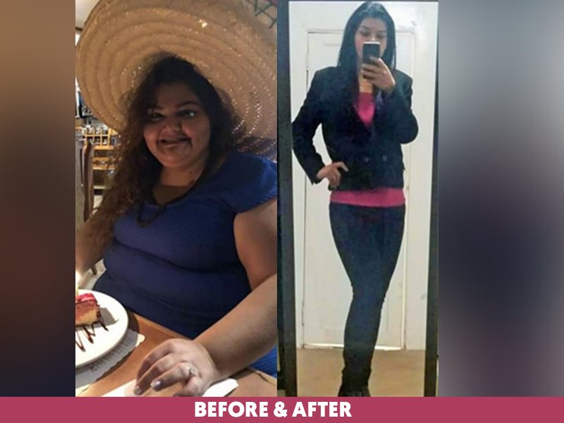 Mely-Before-After-Bariatric-Gastric-Sleeve.png
