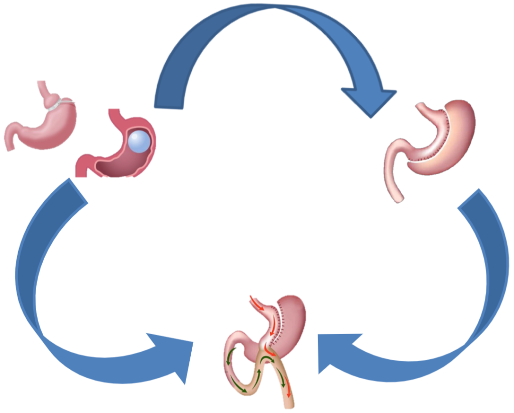 revision surgery diagram