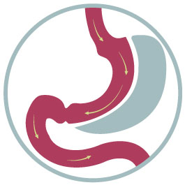 Gastric Sleeve Diagram