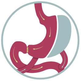 Bariatric Revision Diagram